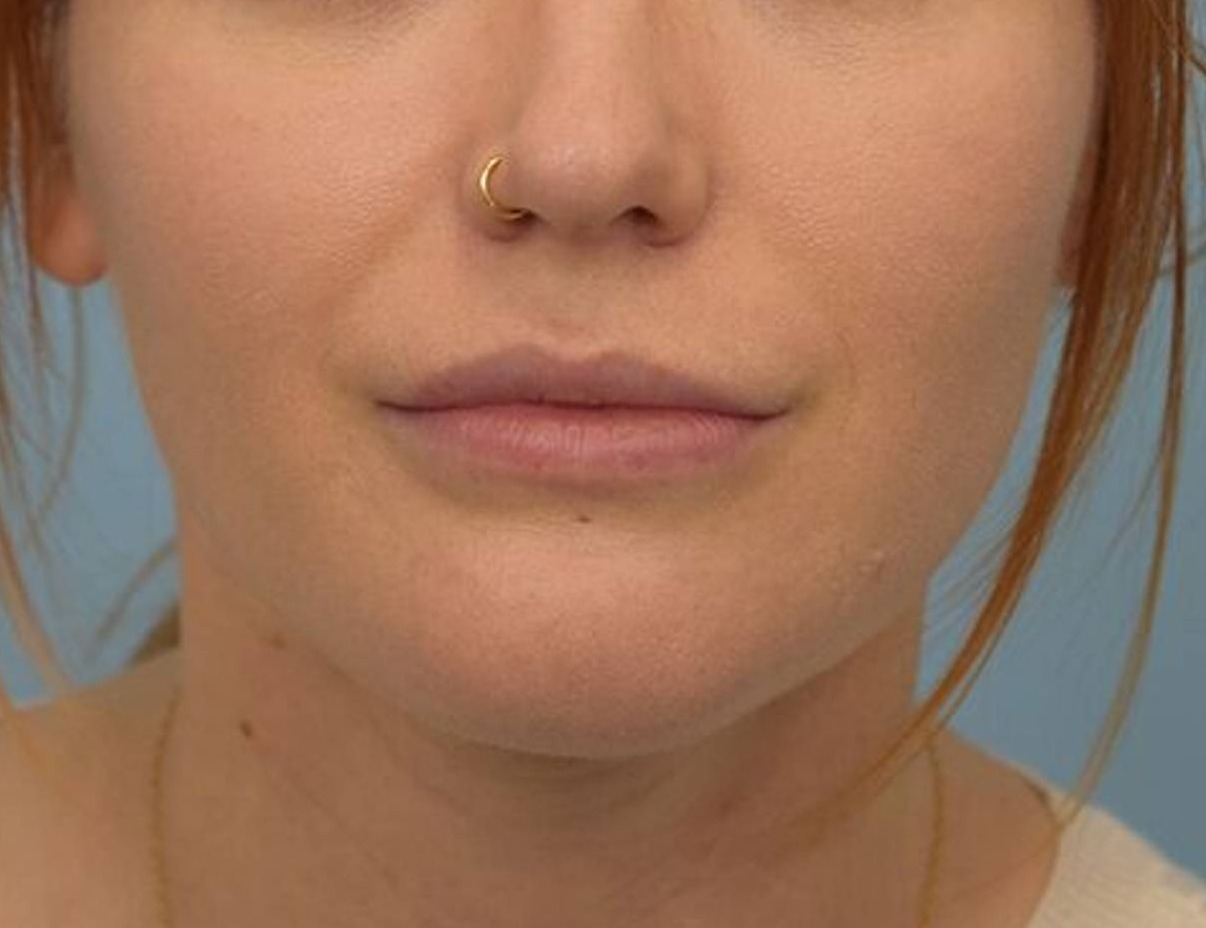 Buccal Fat Removal Before & After Image