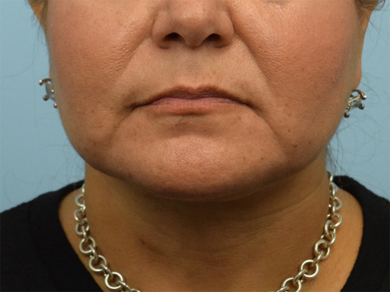 Buccal Fat Pad Removal Photos, Houston, Tx