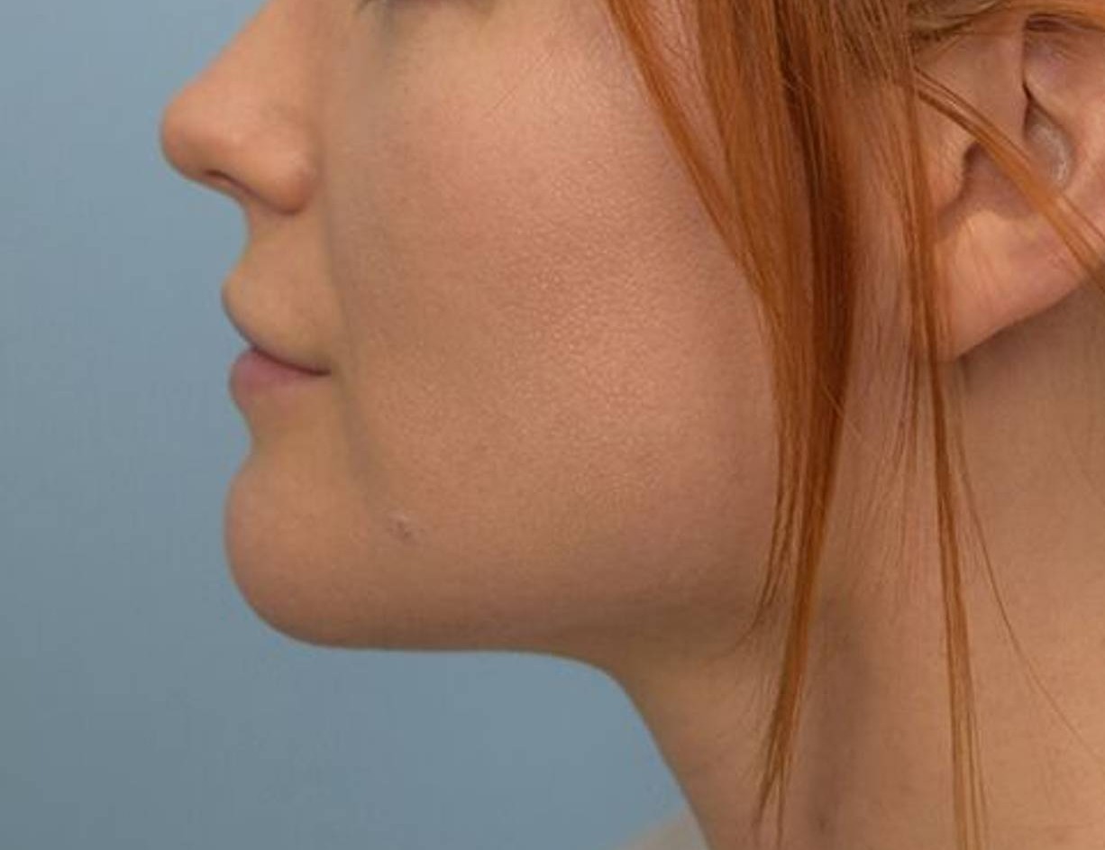 Chin Reduction Before & After Image