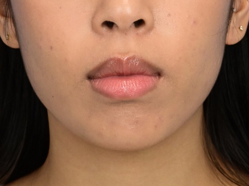 Chin Reduction Before & After Image