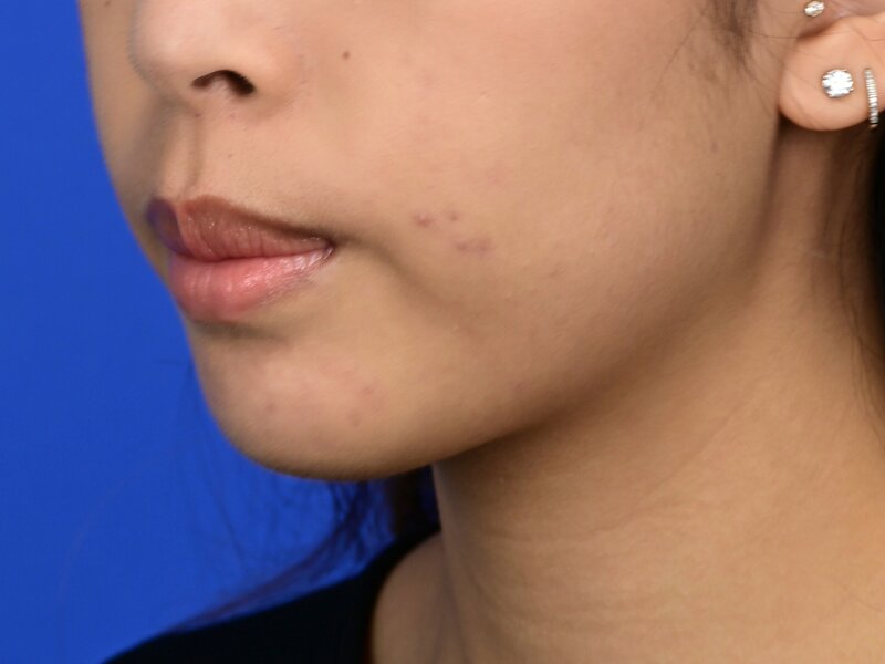 Chin Reduction Before & After Image