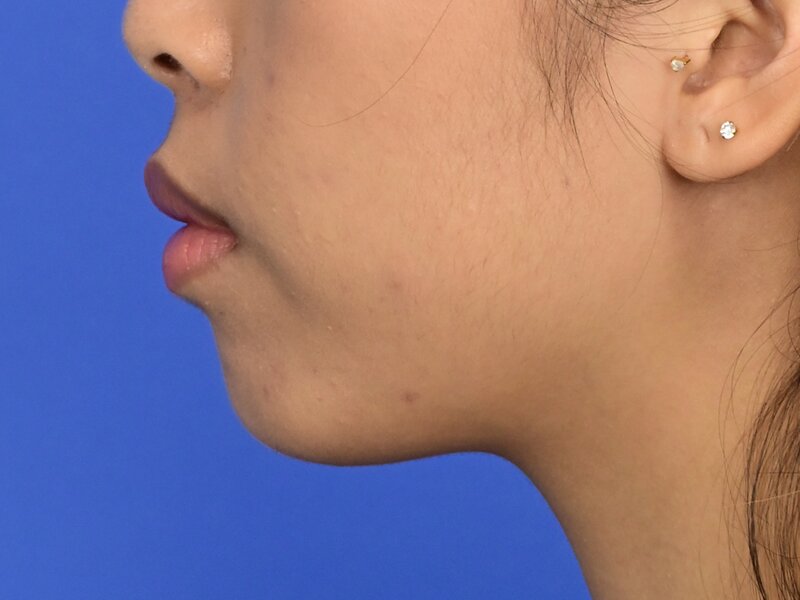 Chin Reduction Before & After Image