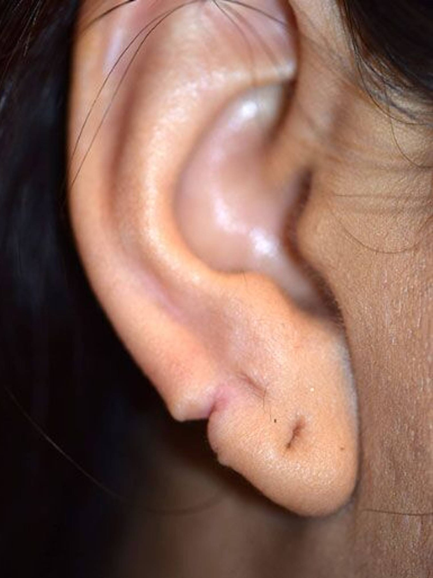 Ear Repair Torn Gauged Earlobe Houston TX