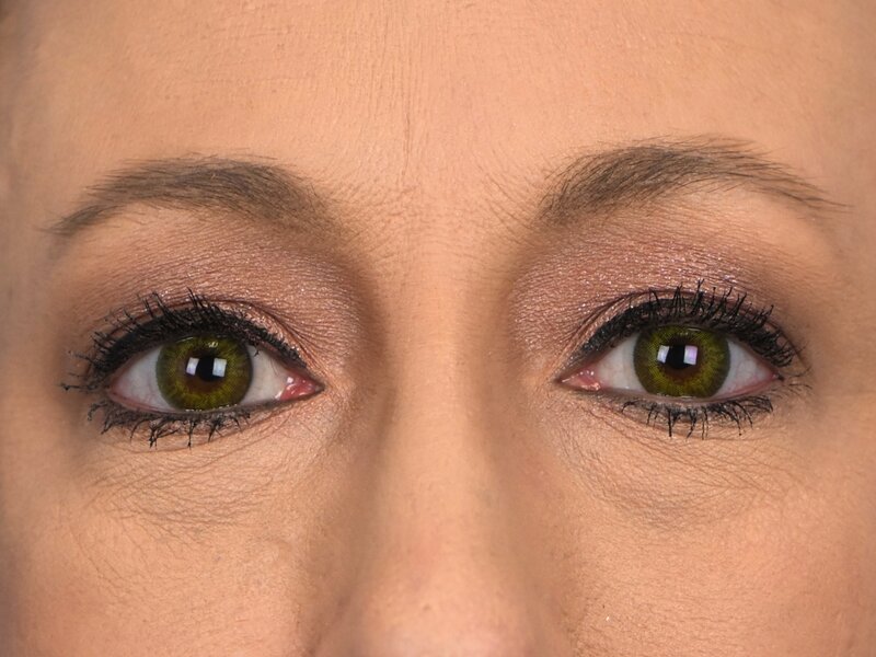 Blepharoplasty Before & After Image