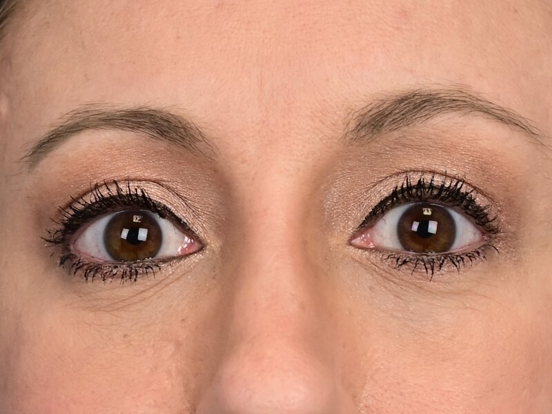 Blepharoplasty Before & After Image