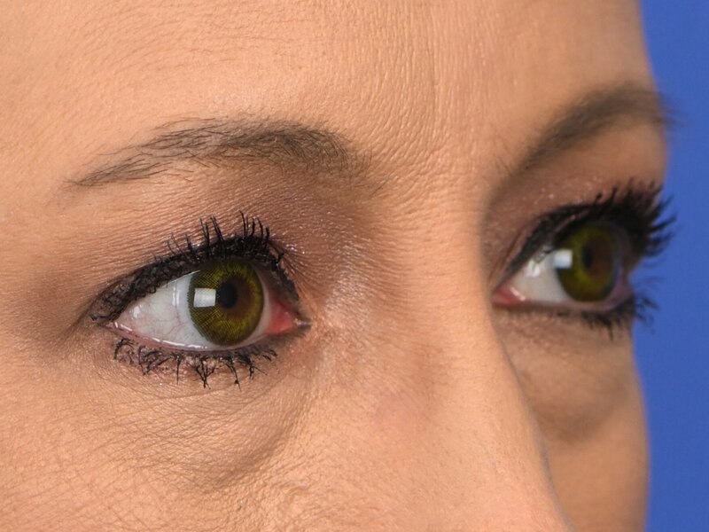 Blepharoplasty Before & After Image