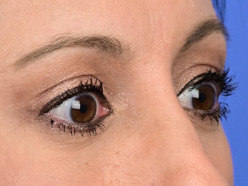 Blepharoplasty Before & After Image