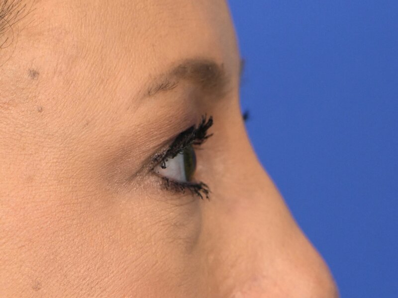 Blepharoplasty Before & After Image