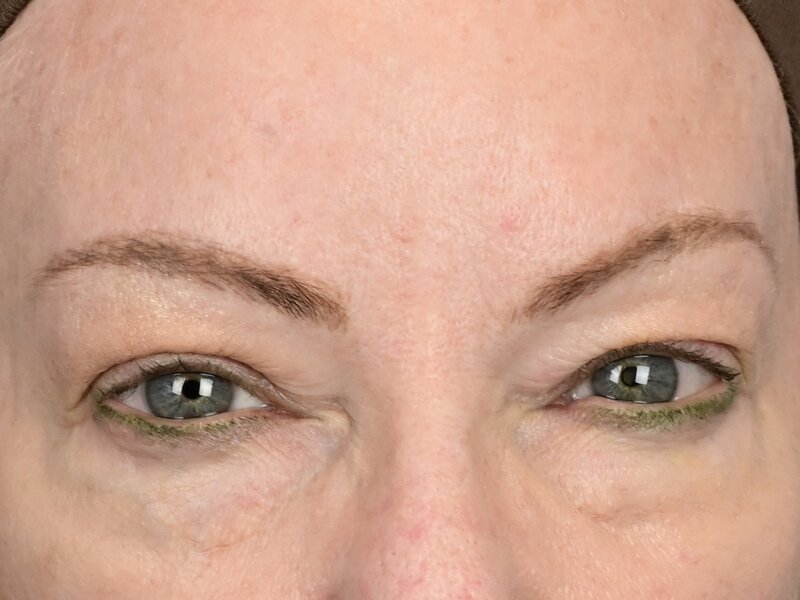 Blepharoplasty Before & After Image