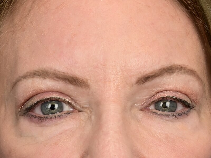 Blepharoplasty Before & After Image