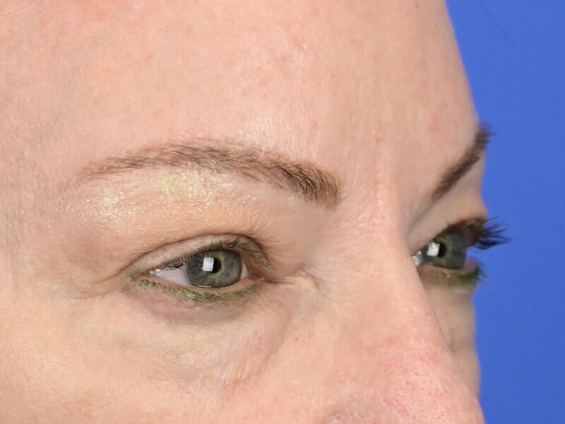 Blepharoplasty Before & After Image