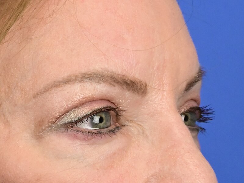 Blepharoplasty Before & After Image