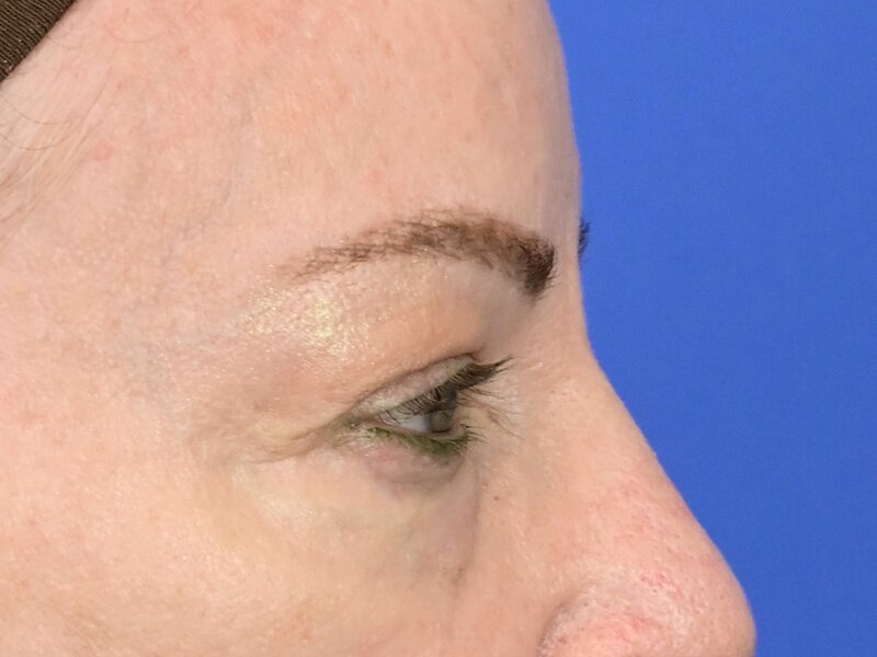 Blepharoplasty Before & After Image