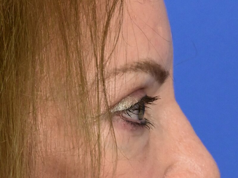 Blepharoplasty Before & After Image