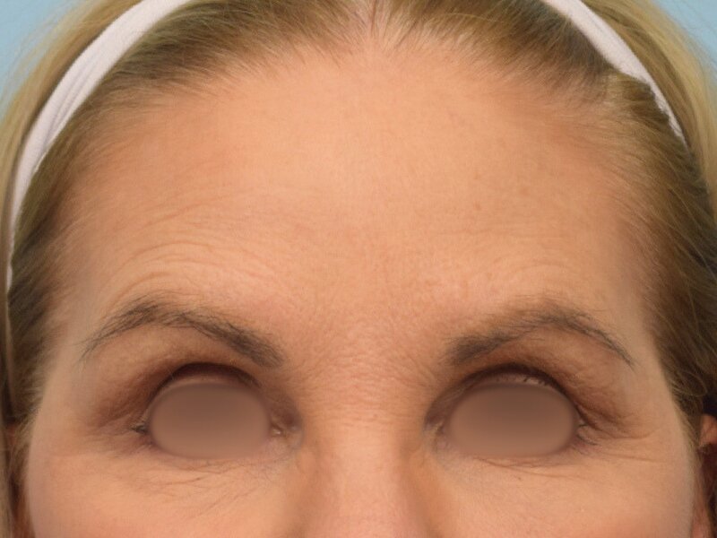 Blepharoplasty Before & After Image