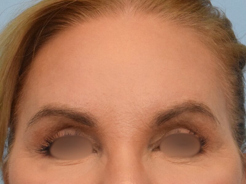 Blepharoplasty Before & After Image