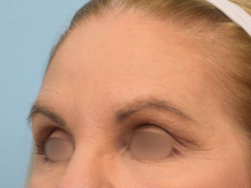 Blepharoplasty Before & After Image