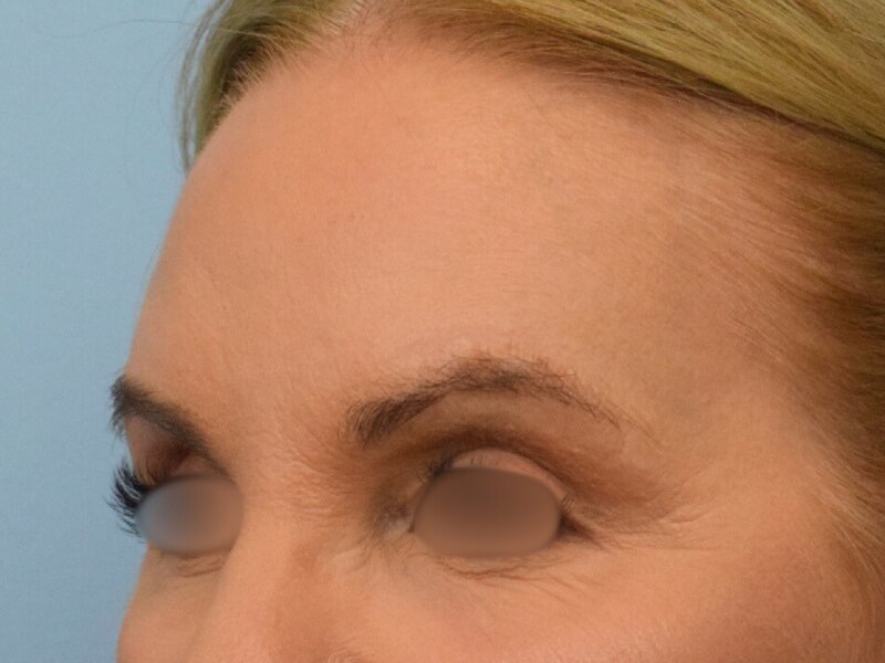 Blepharoplasty Before & After Image