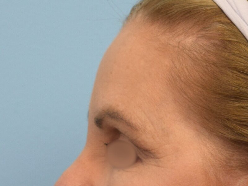 Blepharoplasty Before & After Image