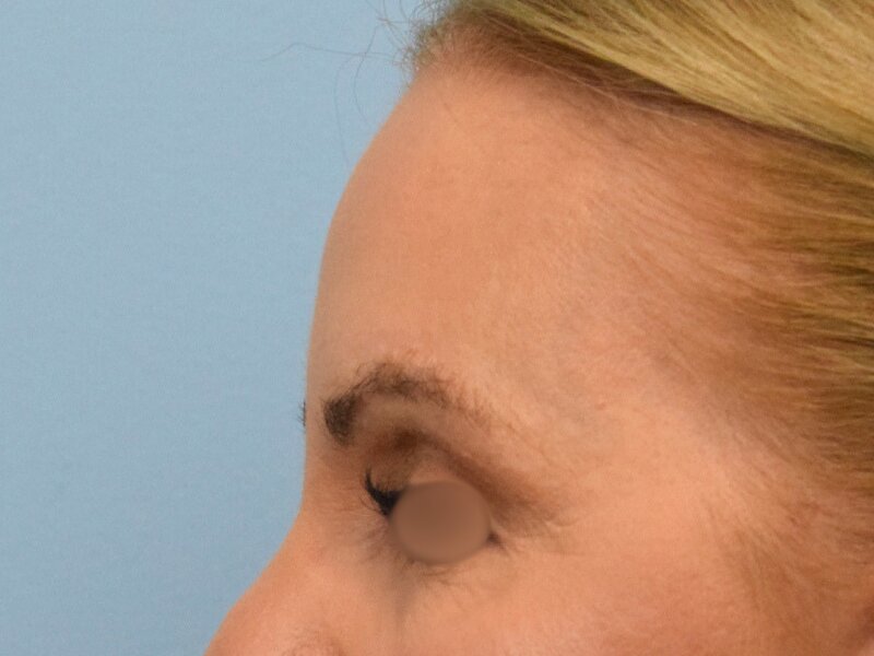 Blepharoplasty Before & After Image