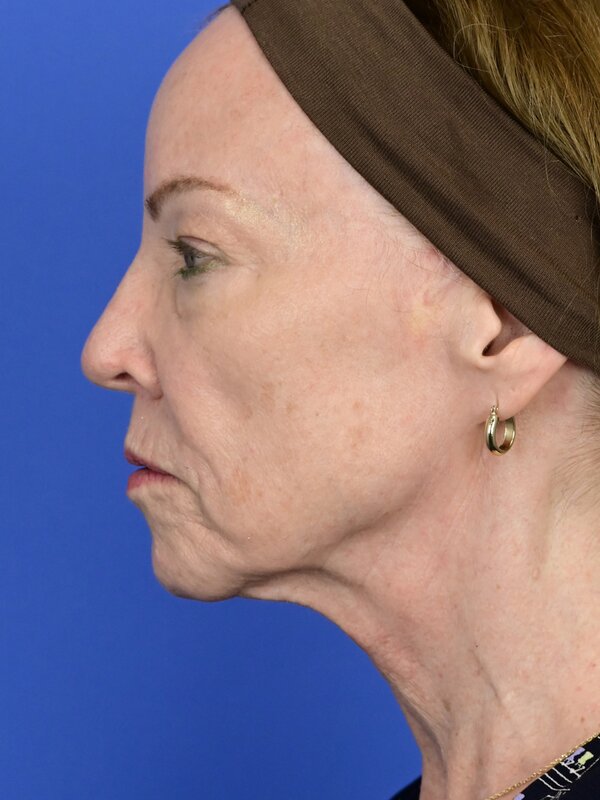 Face & Neck Lift Before & After Image