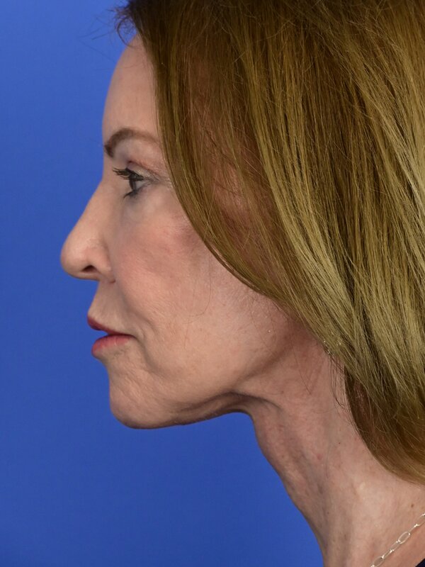 Face & Neck Lift Before & After Image