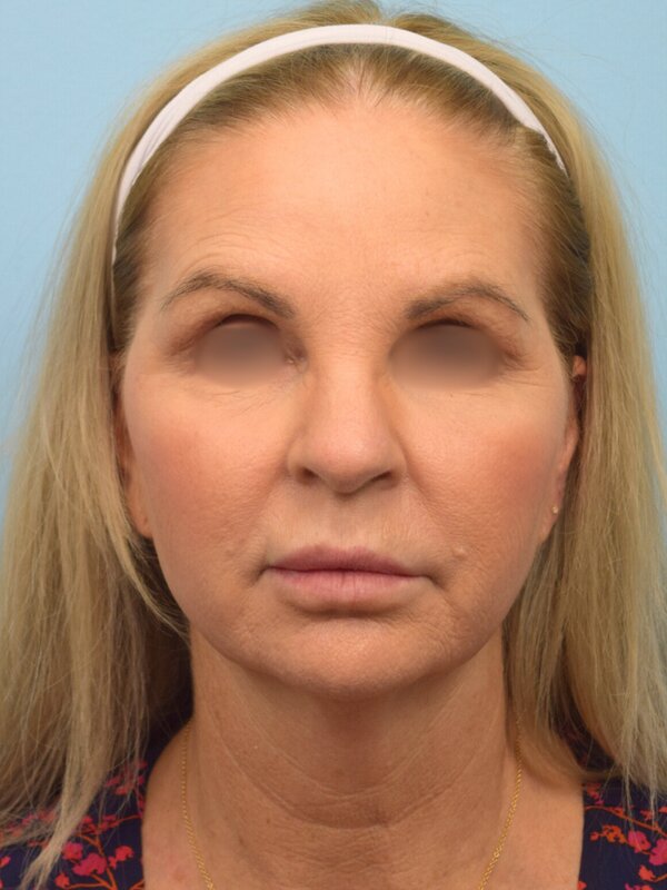 Face & Neck Lift Before & After Image