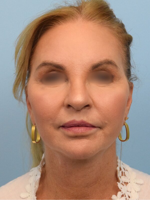 Face & Neck Lift Before & After Image