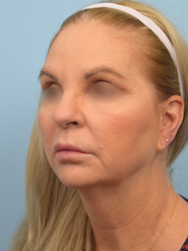 Face & Neck Lift Before & After Image