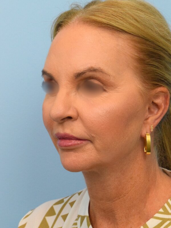 Face & Neck Lift Before & After Image