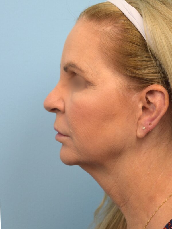 Face & Neck Lift Before & After Image