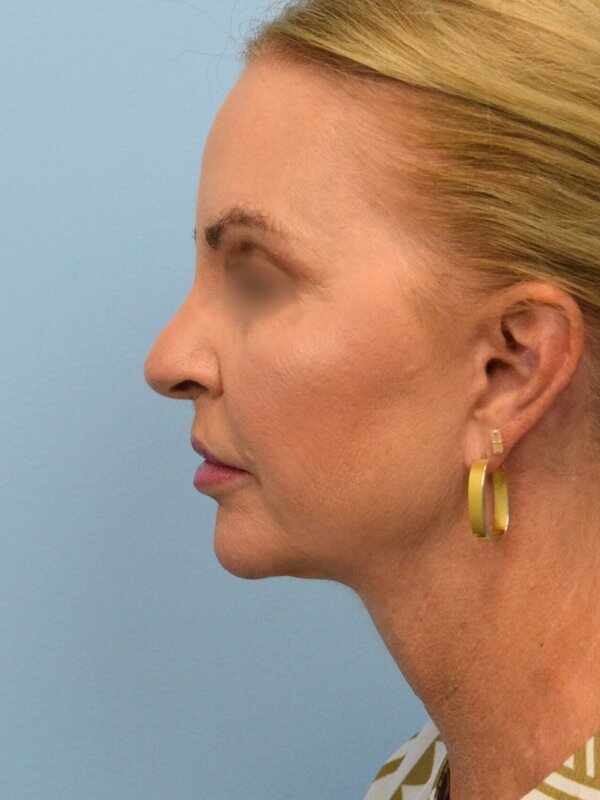 Face & Neck Lift Before & After Image