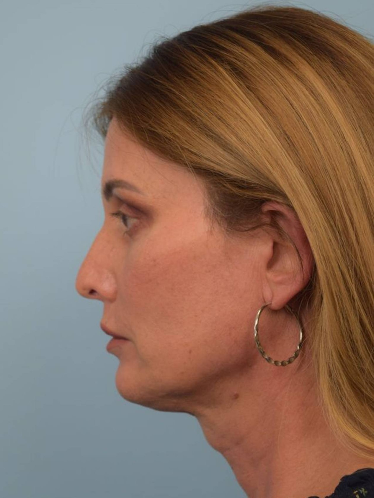 Facial Feminization Surgery Before & After Image