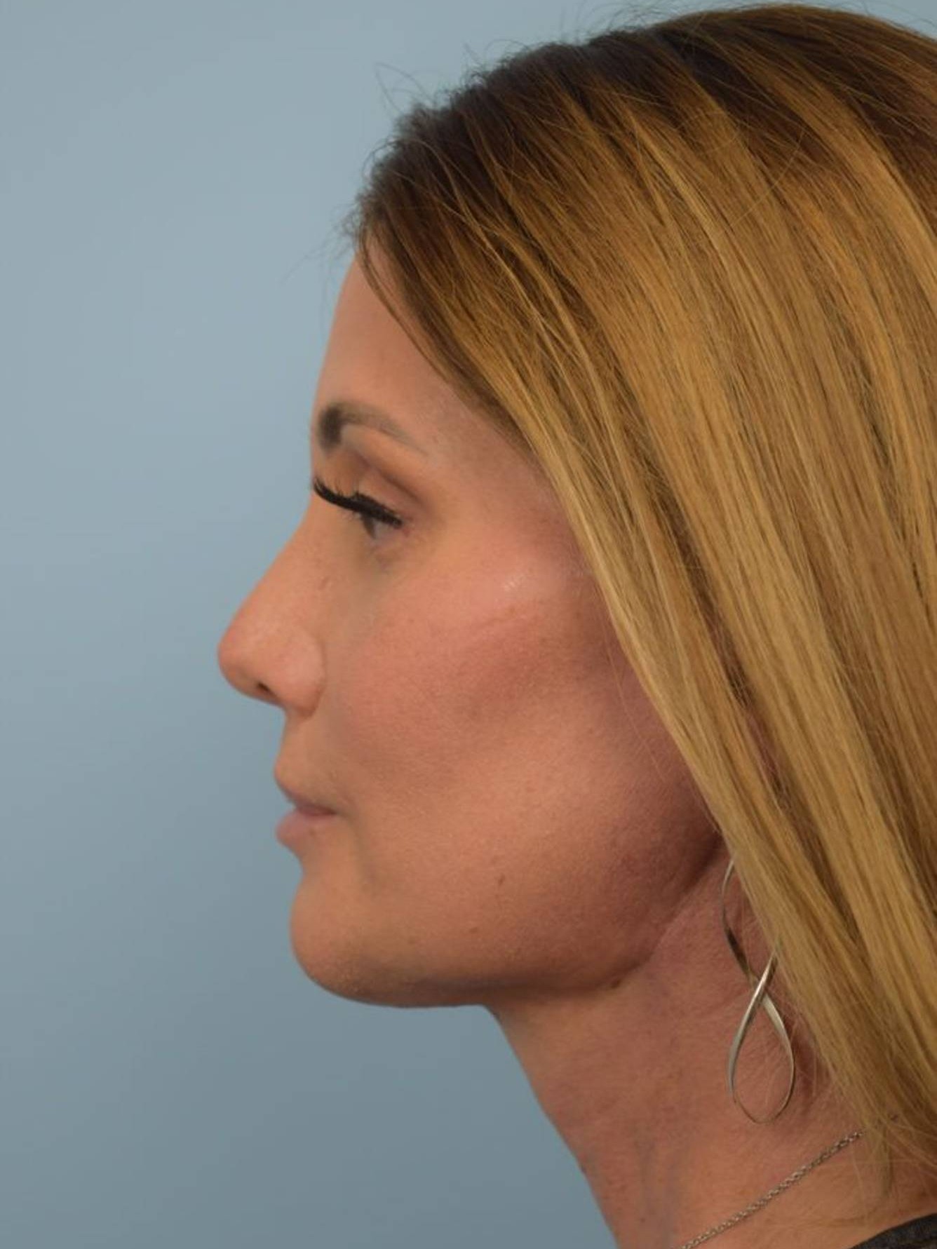 Facial Feminization Surgery Before & After Image