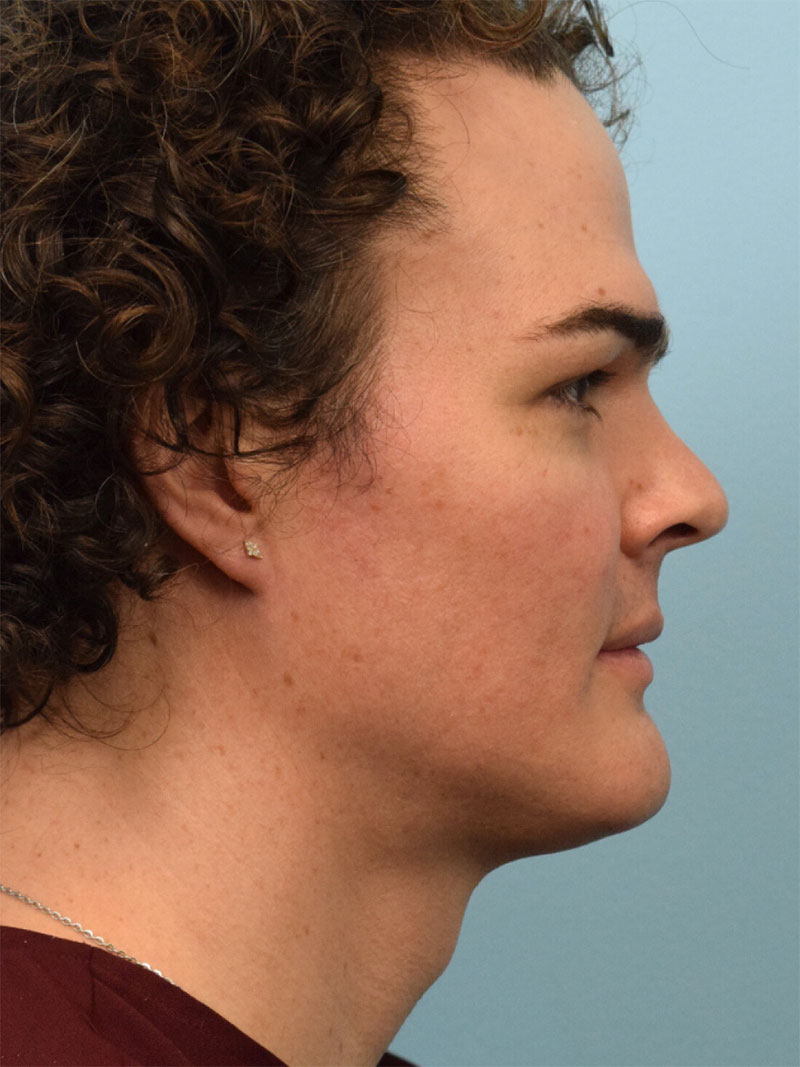 Facial Feminization Surgery Before & After Image