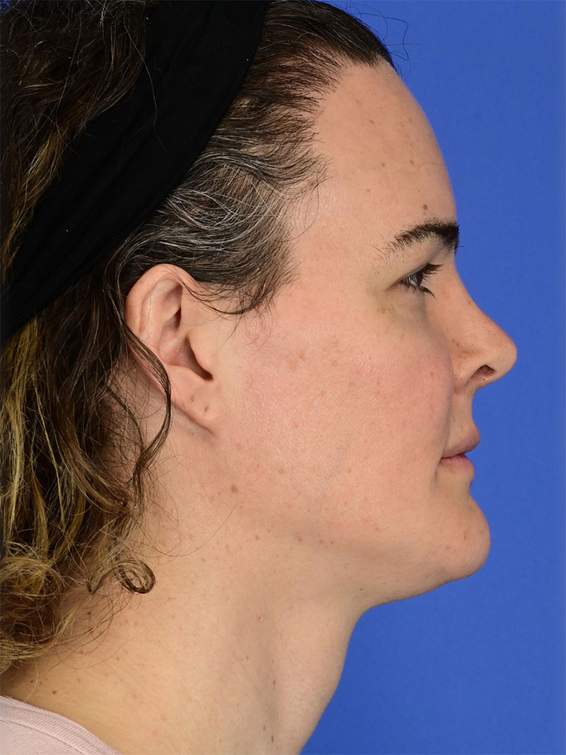 Facial Feminization Surgery Before & After Image