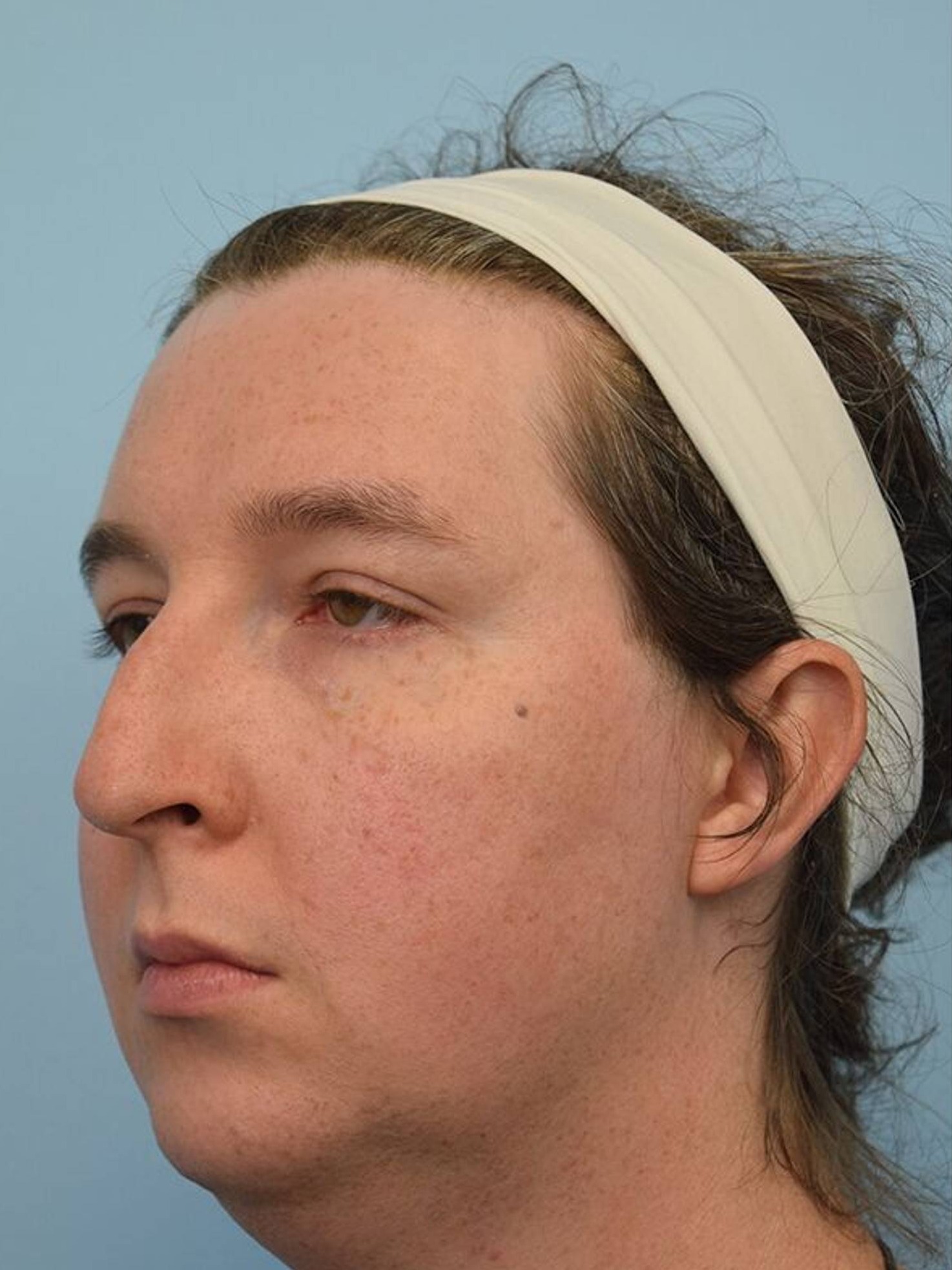 Facial Feminization Surgery Before & After Image