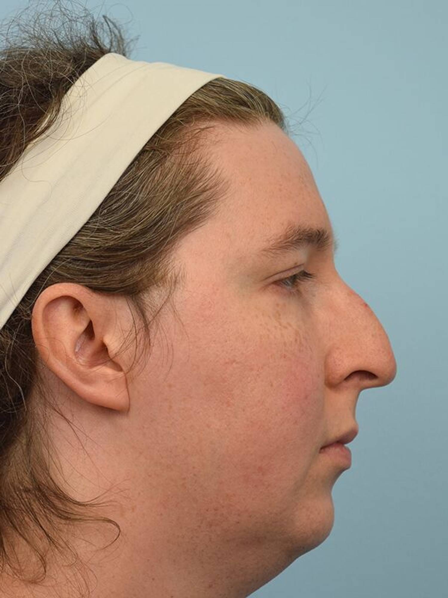 Facial Feminization Surgery Before & After Image