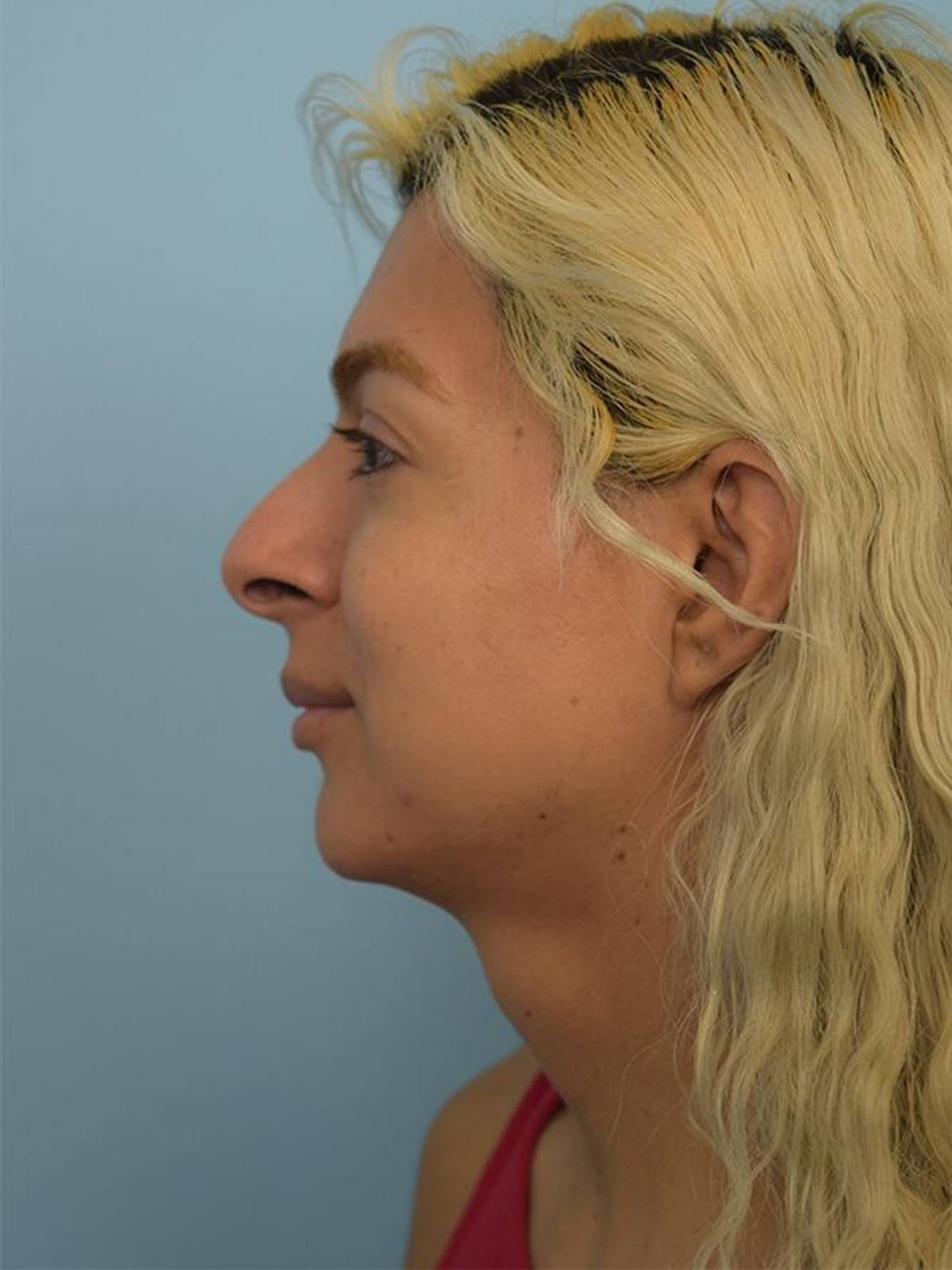 Facial Feminization Surgery Before & After Image