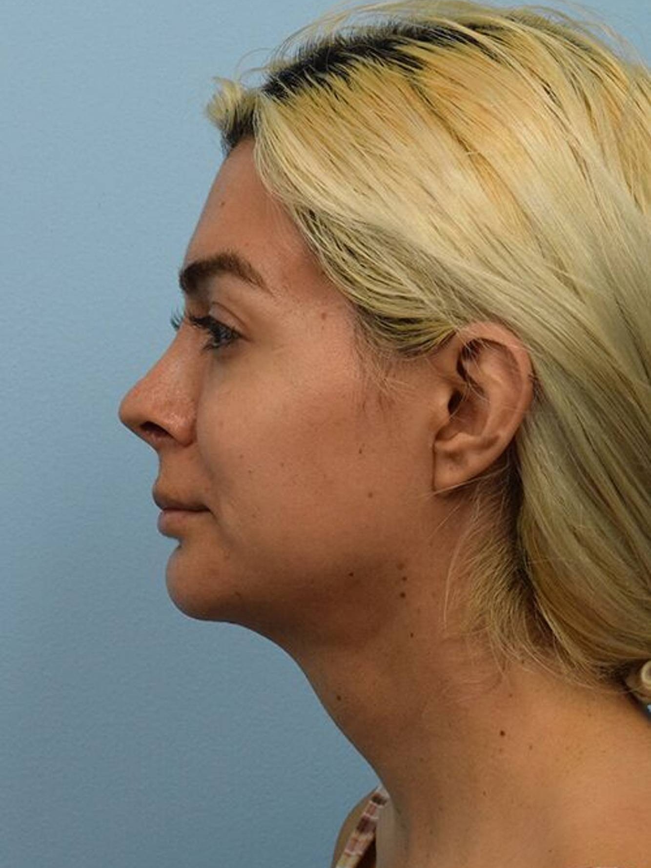 Facial Feminization Surgery Before & After Image