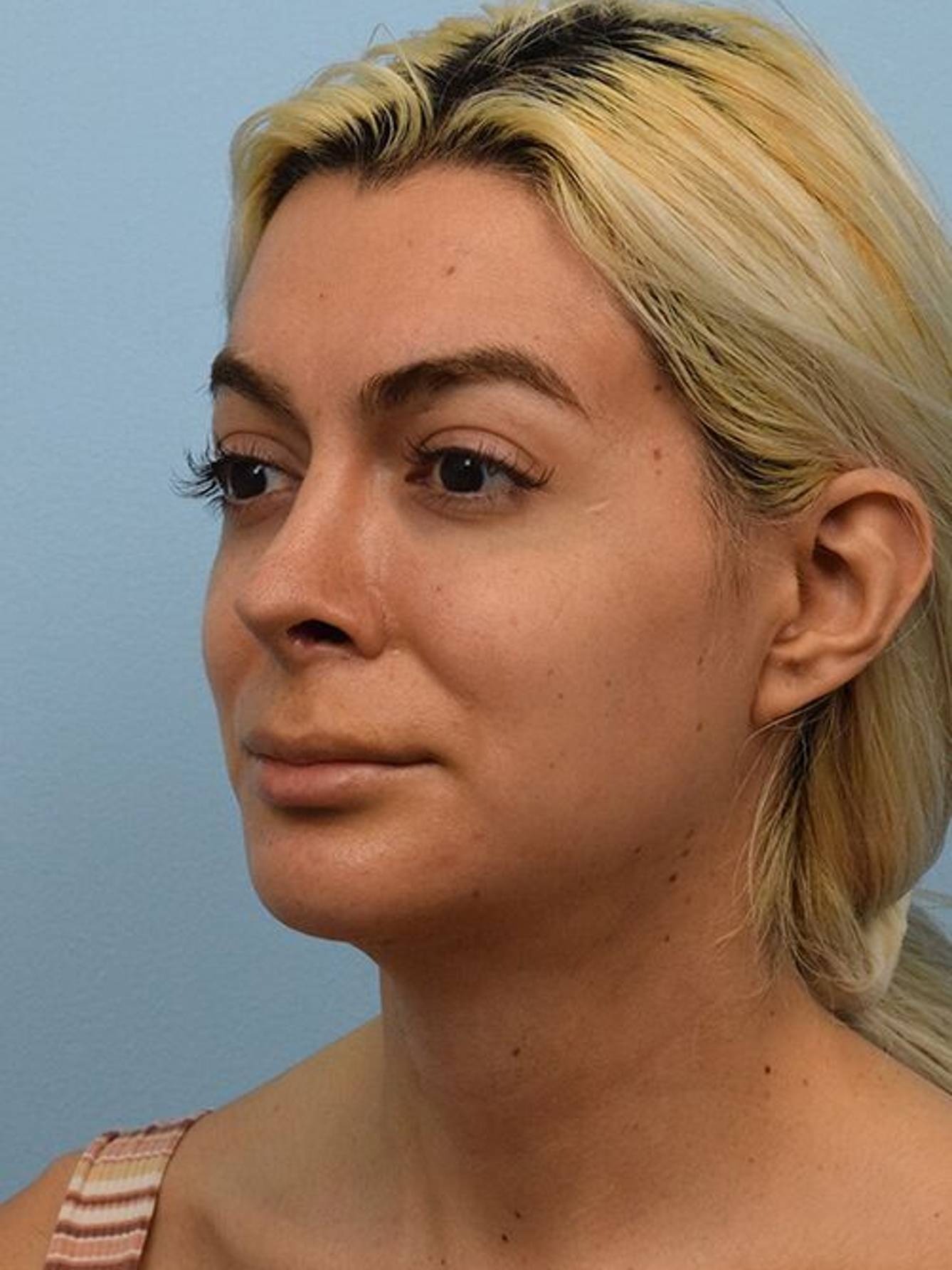 Facial Feminization Surgery Before & After Image