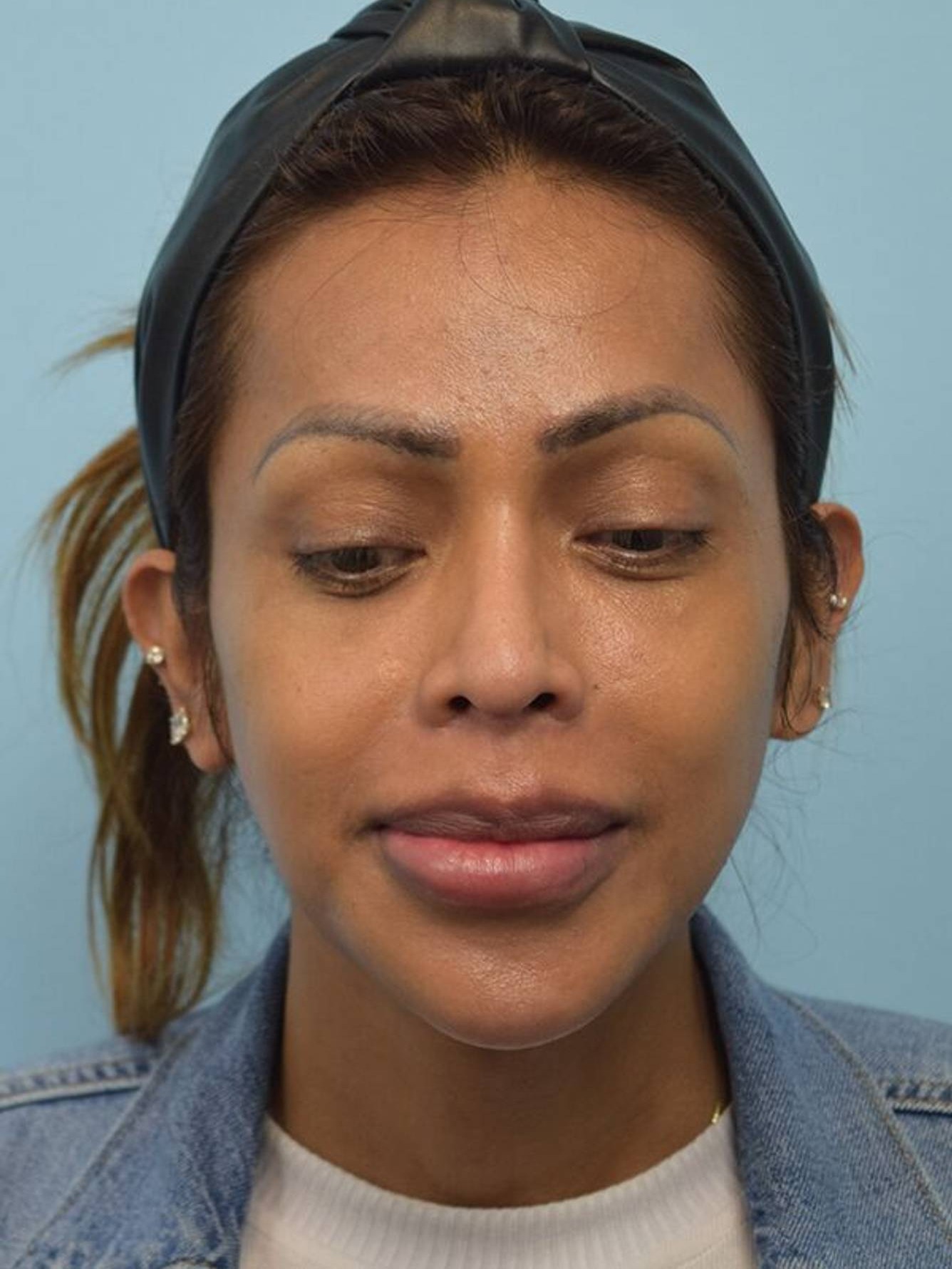 Facial Feminization Surgery Before & After Image