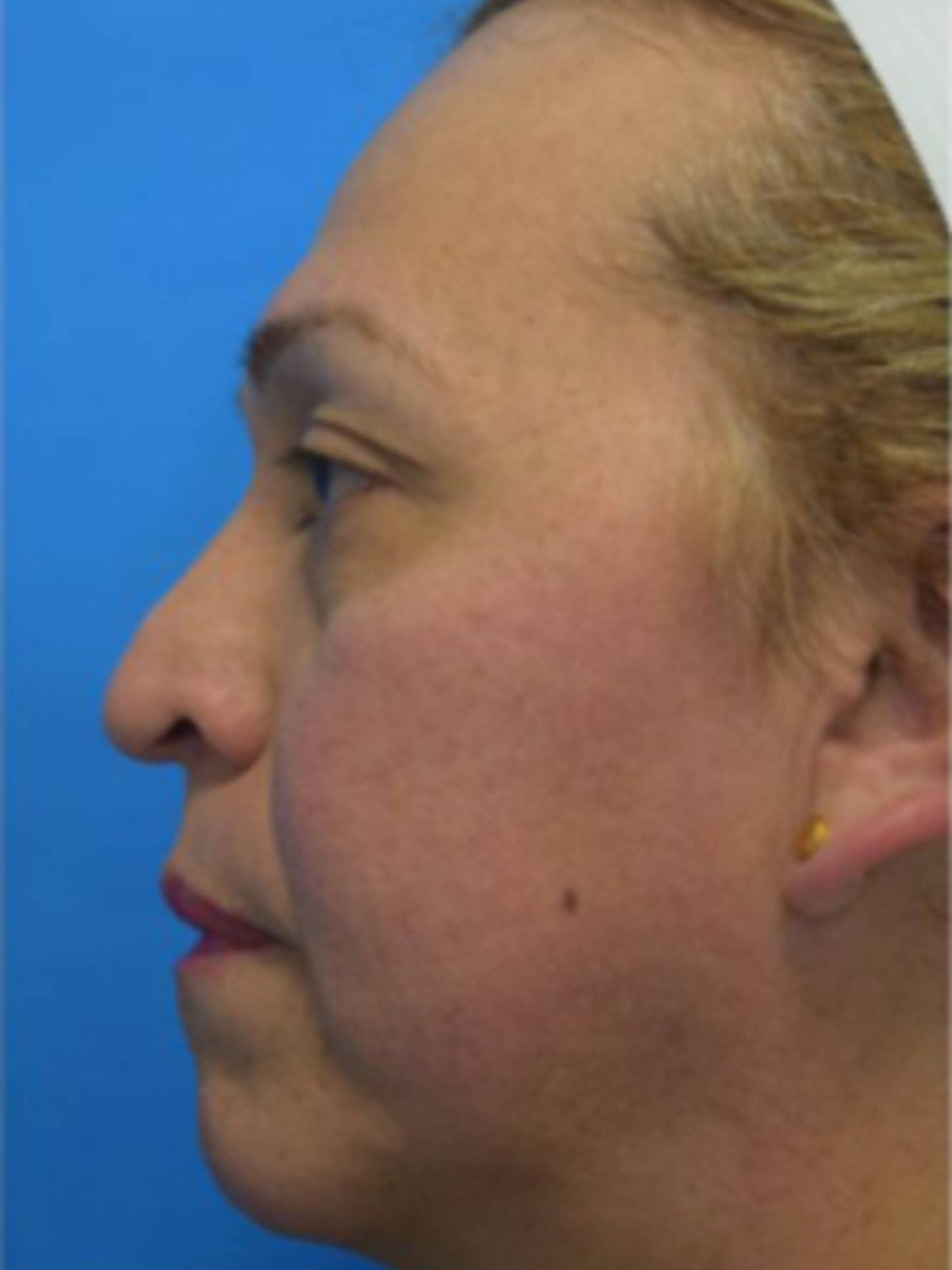 Facial Feminization Surgery Before & After Image