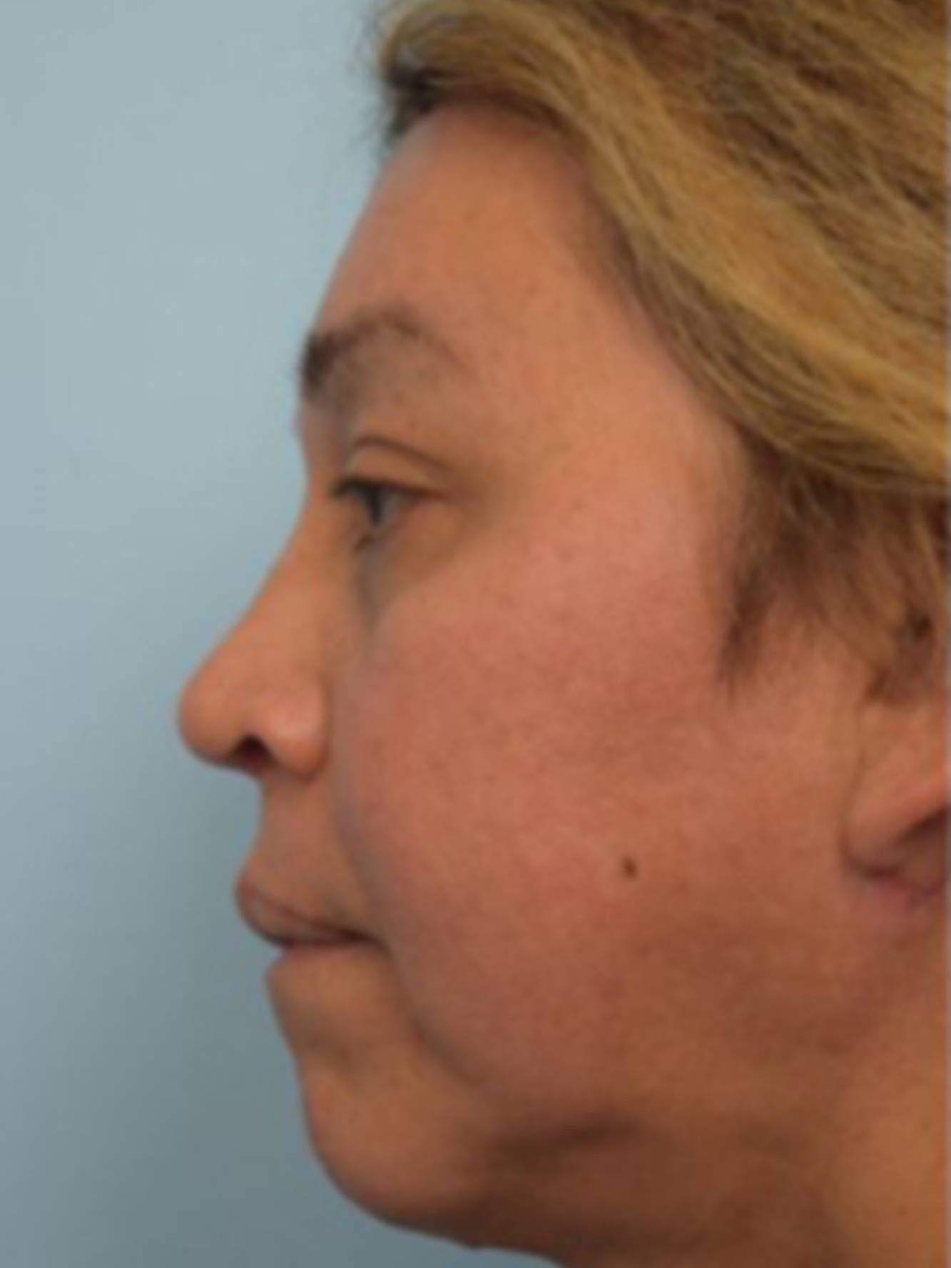 Facial Feminization Surgery Before & After Image