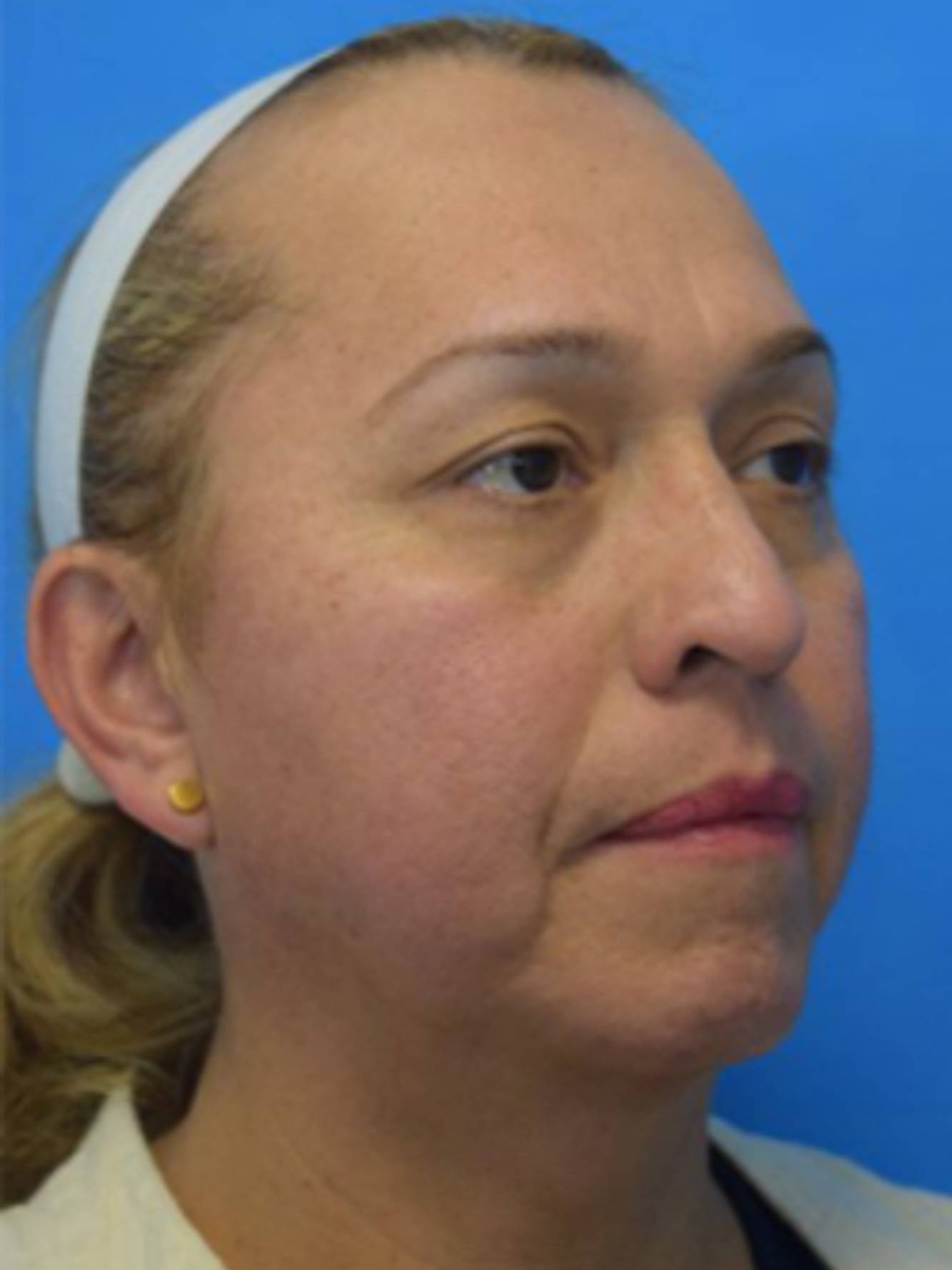 Facial Feminization Surgery Before & After Image