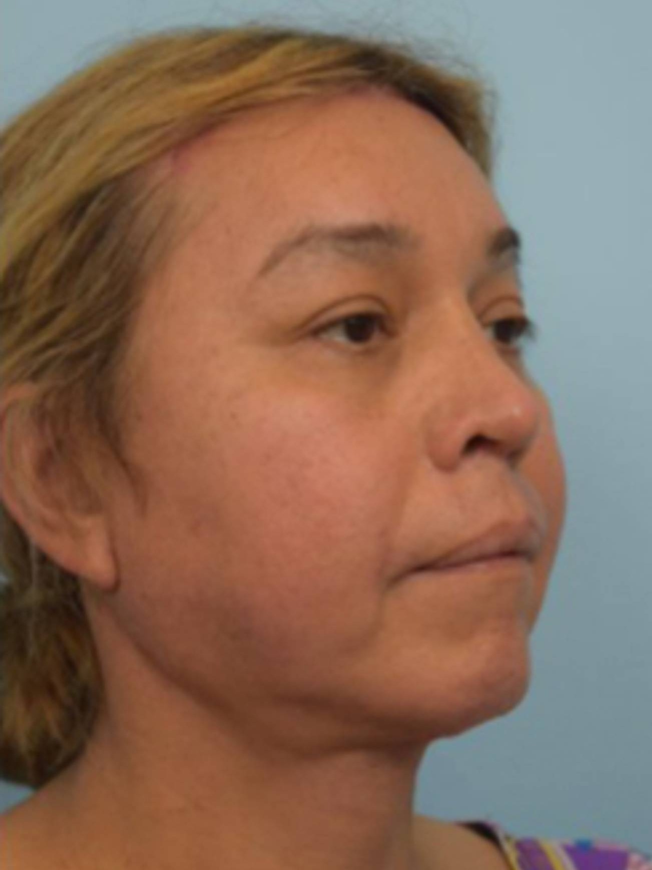 Facial Feminization Surgery Before & After Image