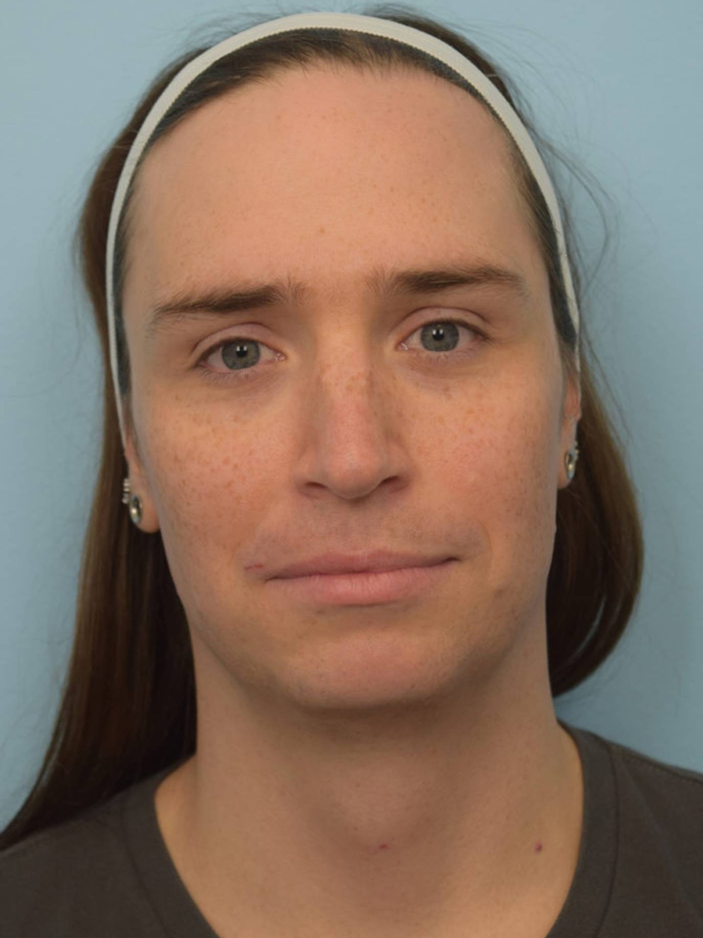 Facial Feminization Surgery Before & After Image