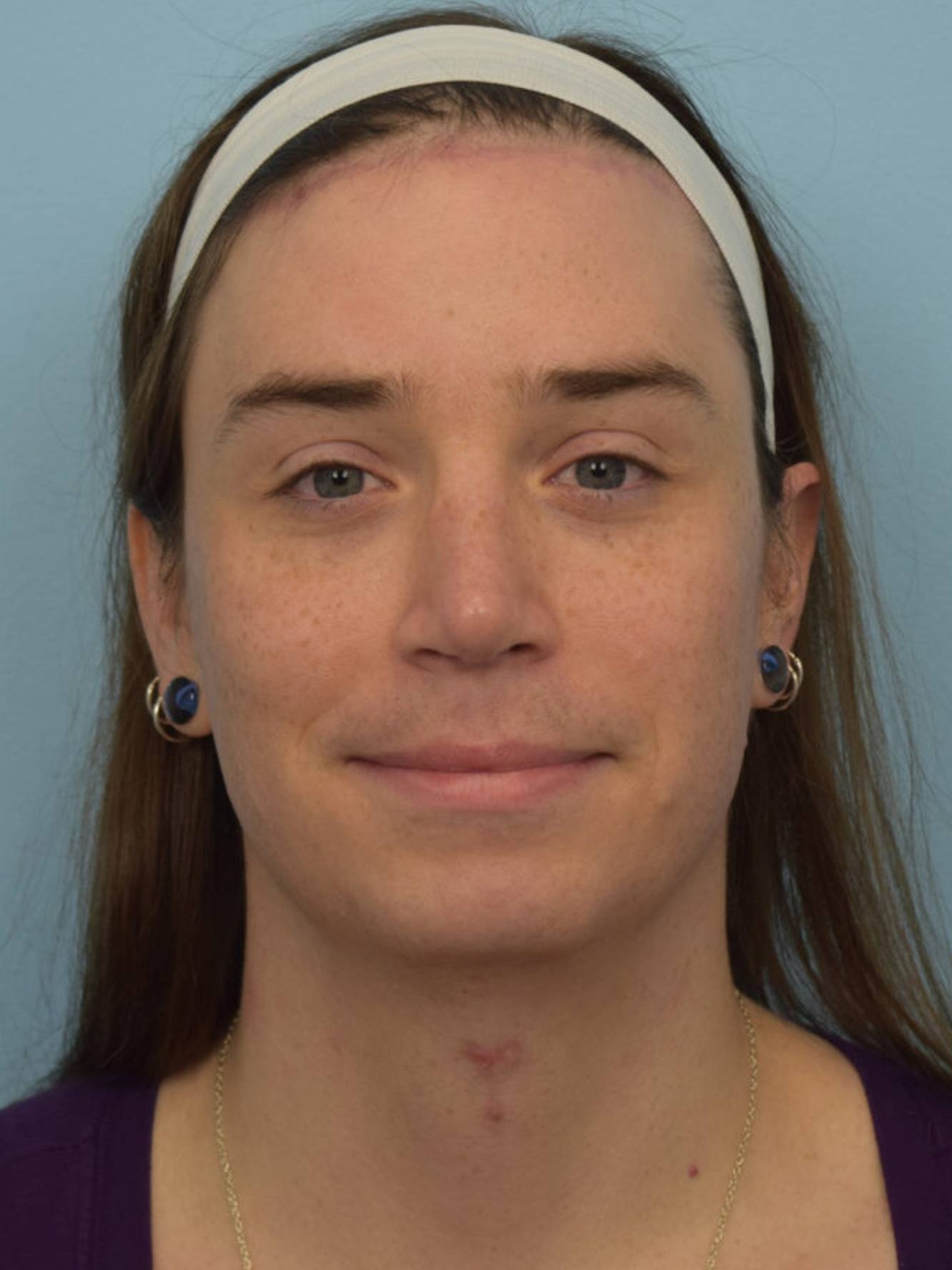 Facial Feminization Surgery Before & After Image