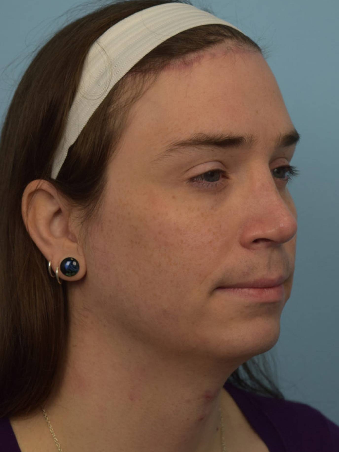 Facial Feminization Surgery Before & After Image