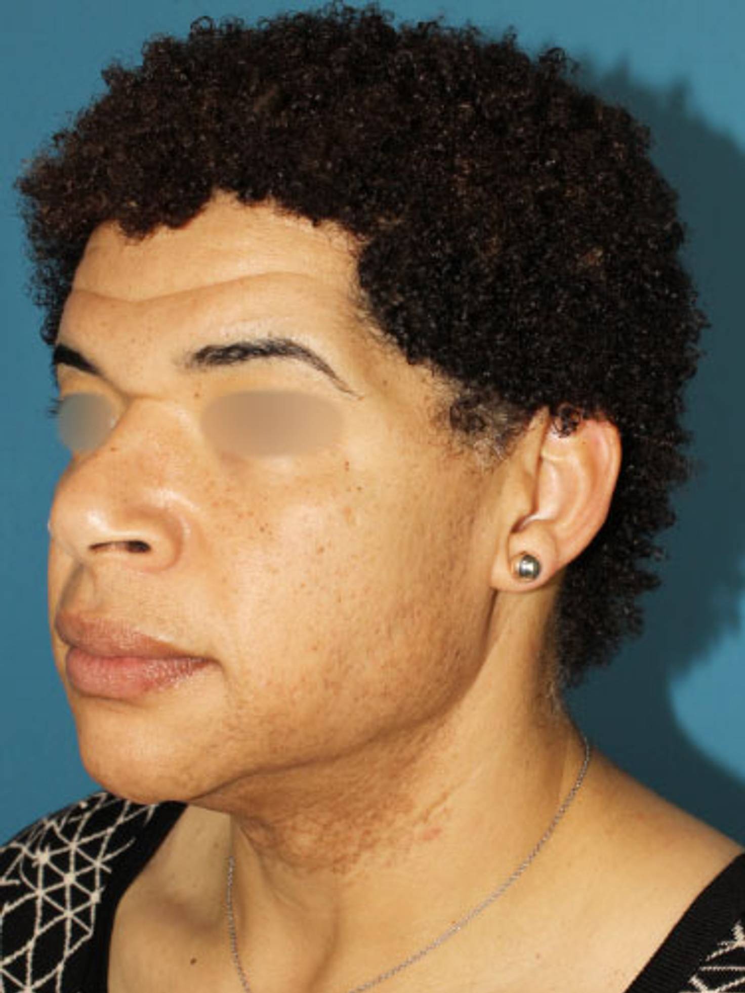 Facial Feminization Surgery Before & After Image